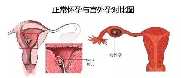 喜得好孕：什么是宫外孕以及治疗方法？
