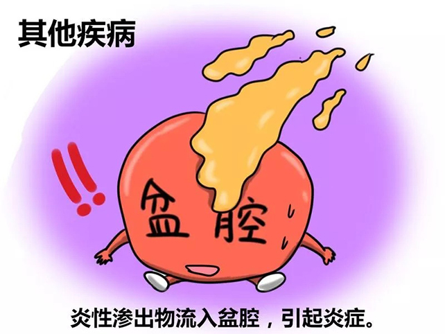 喜得好孕：盆腔炎的潜在危险
