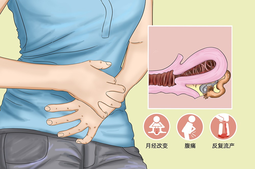 喜得贝贝：患有子宫内膜异位症，导致八年未孕，经历了三次试管手术的失败