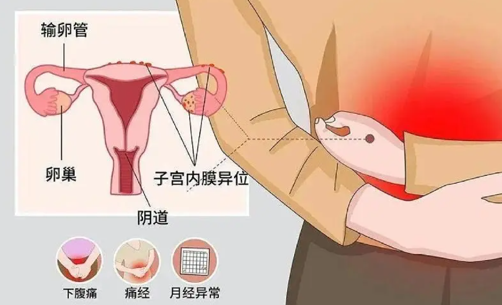 喜得贝贝：如何预防内膜炎的反复发作？