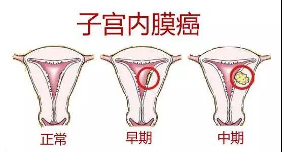喜得贝贝：患有子宫内膜癌，还有可能怀孕生育吗？